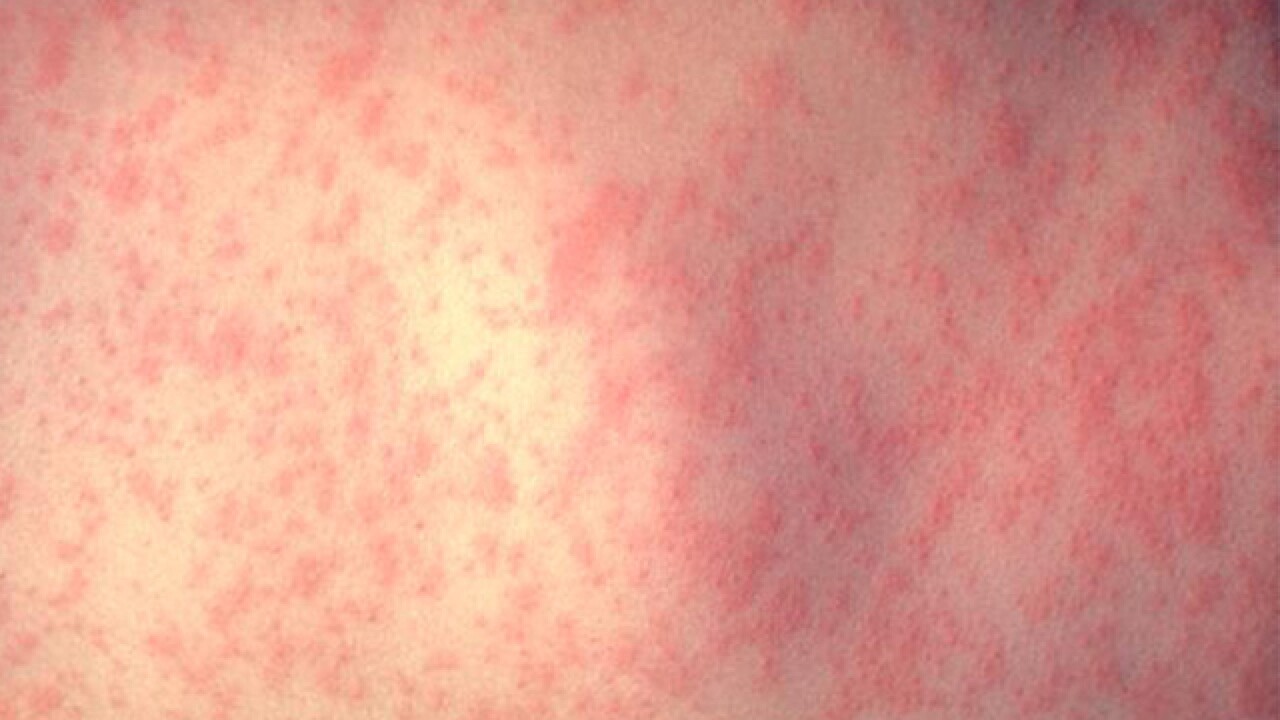 Measles Alerts Issued for Western Sydney and Gold Coast | Stay Informed